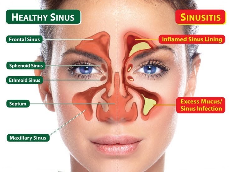 Functional Endoscopic Sinus Surgery