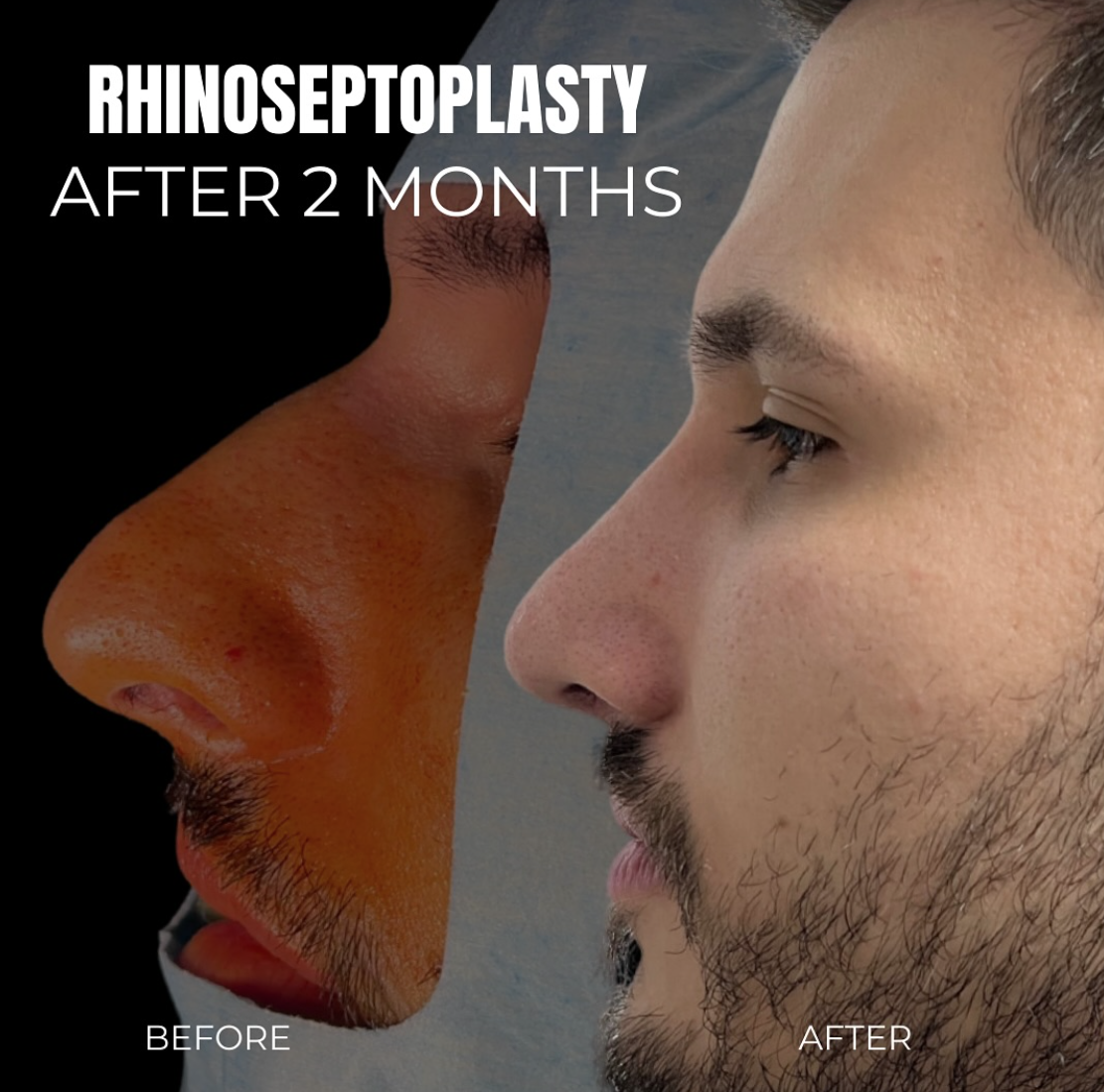 Rinoplastie beneficii