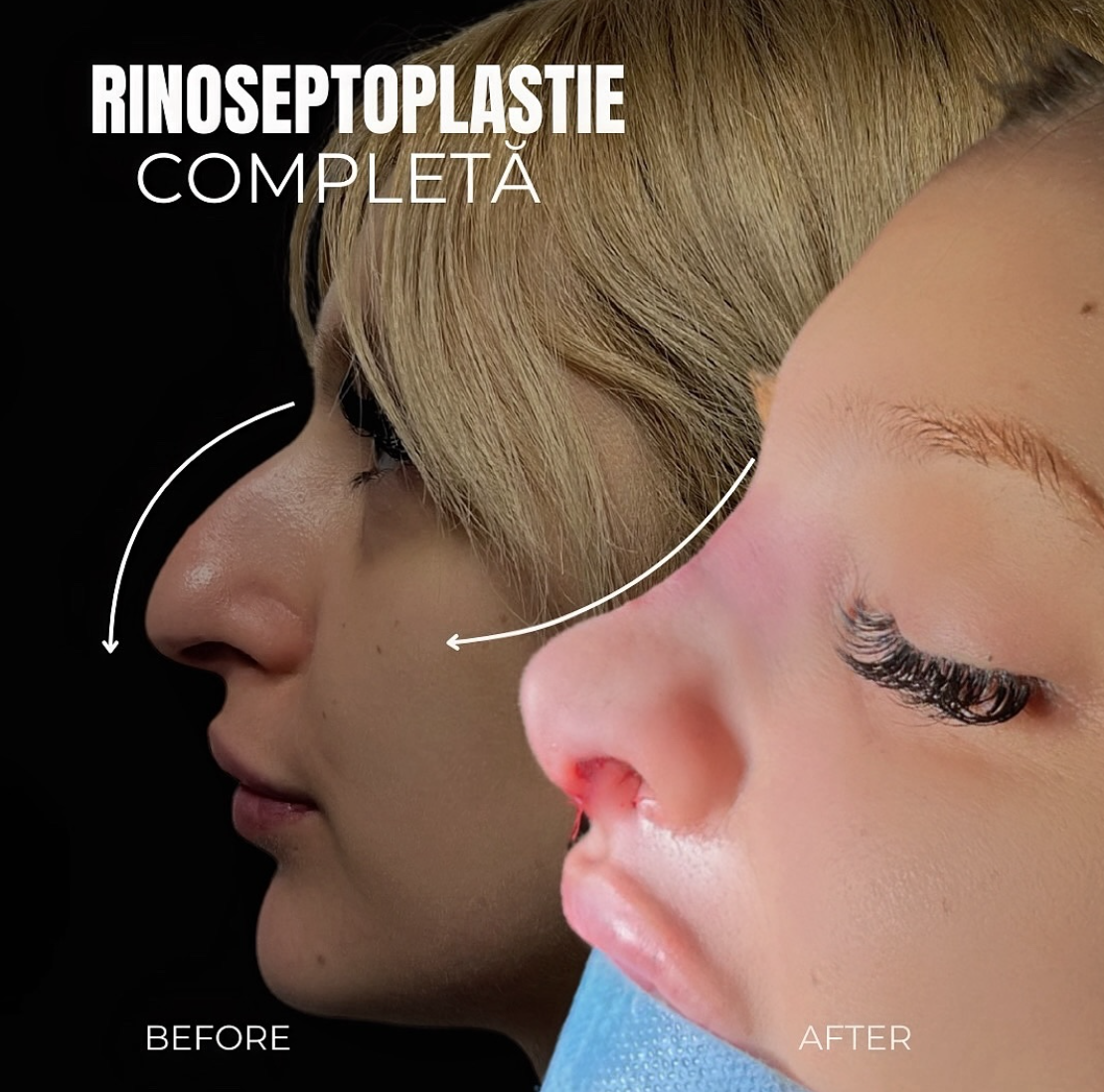 Rinoplastie 