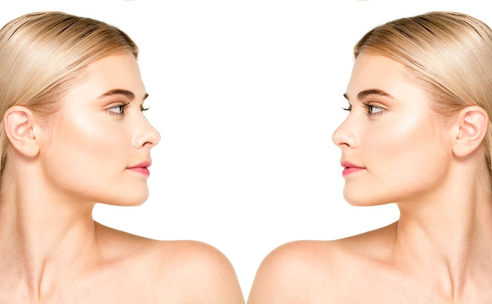 Septoplastie vs Rinoplastie – când se combină?