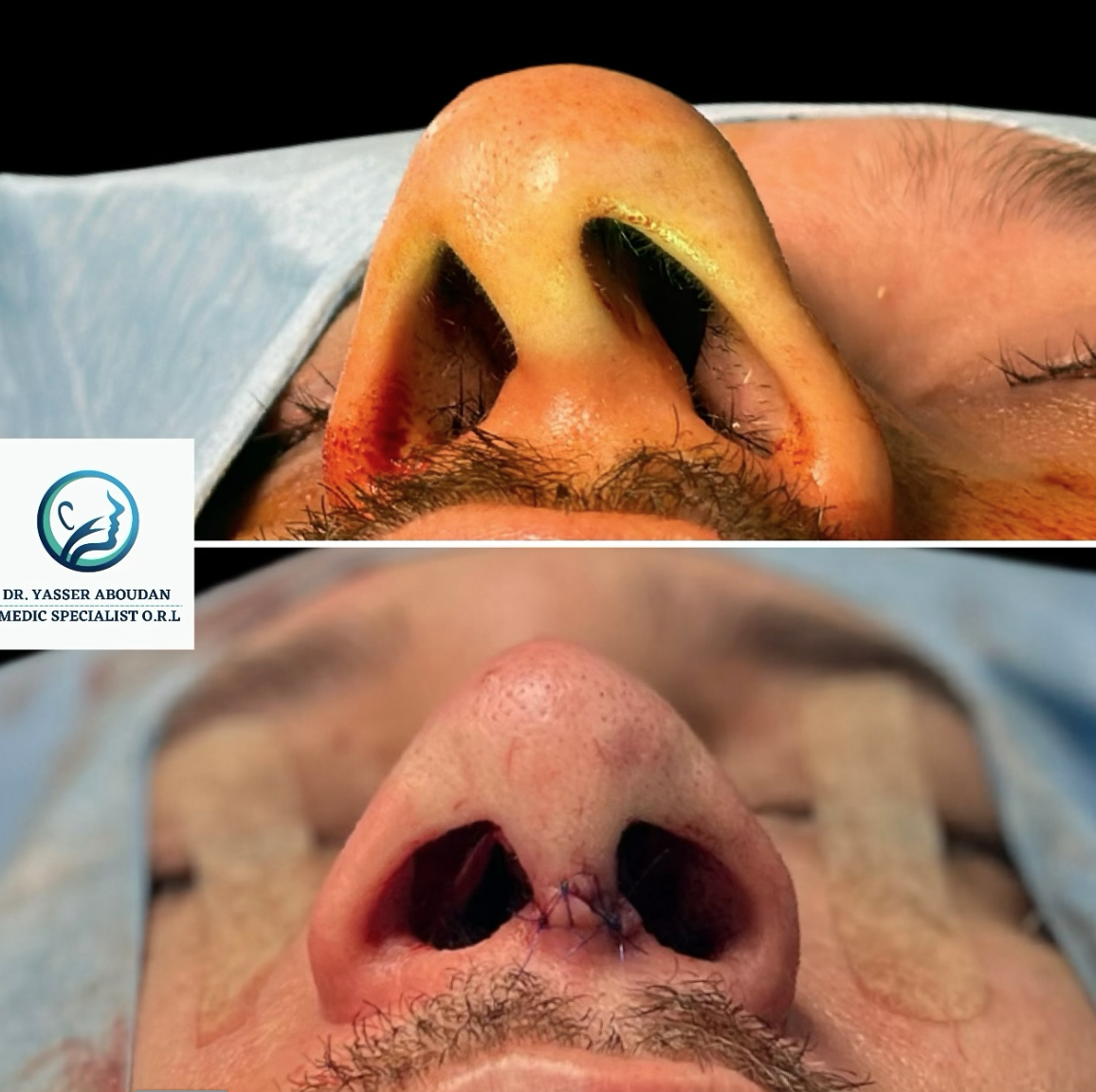 Înainte și imediat după operația de rinoseptoplastie