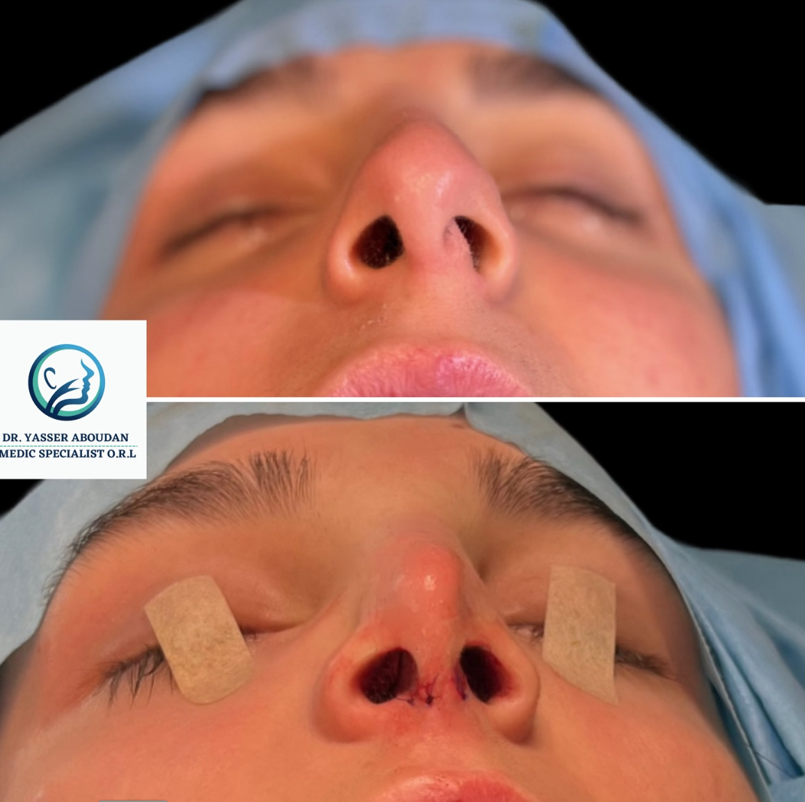 Cum te vei simți imediat după operație?